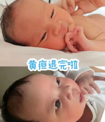 新生兒黃疸原因