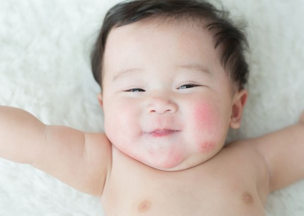 嬰兒起疹子治療