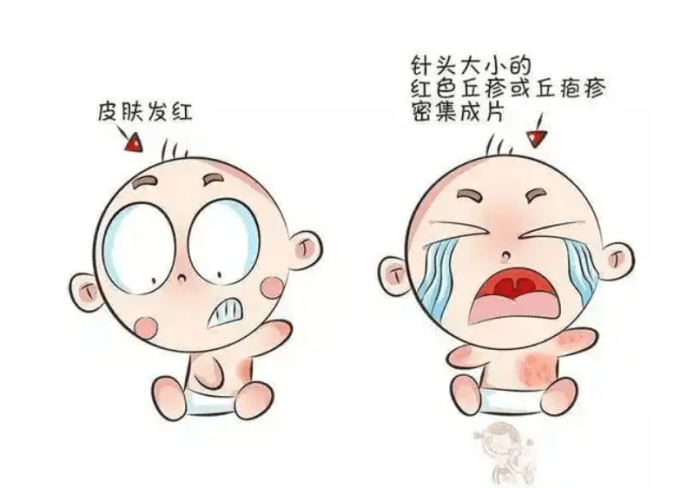 嬰兒熱疹 嬰兒熱疹