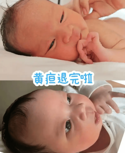 新生兒黃疸指數 新生兒黃疸指數