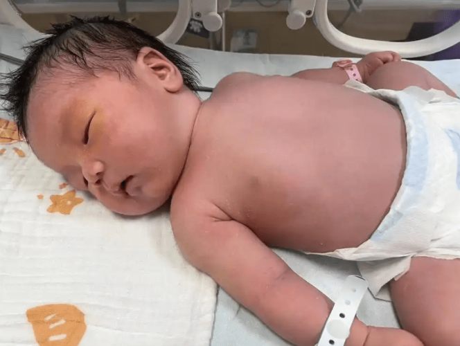 新生兒黃疸症狀