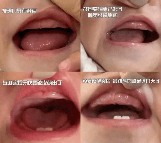 嬰兒長牙症狀
