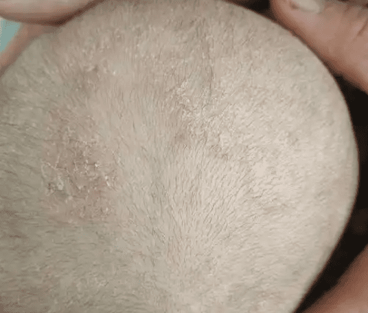 脂漏性皮膚炎嬰兒